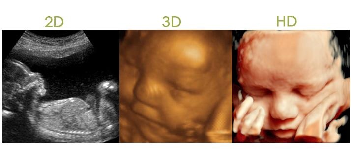 Ultrasonido 4D HD live y Doppler color