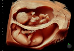 ultrasonido hd live 3d 4d Guadalajara Jalisco México