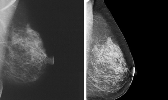 Mamografía y tomosintesis 3D