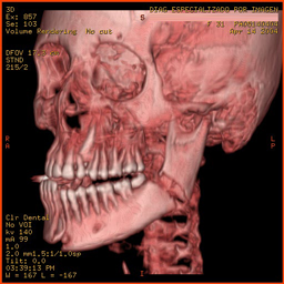 Fractura de mandíbula