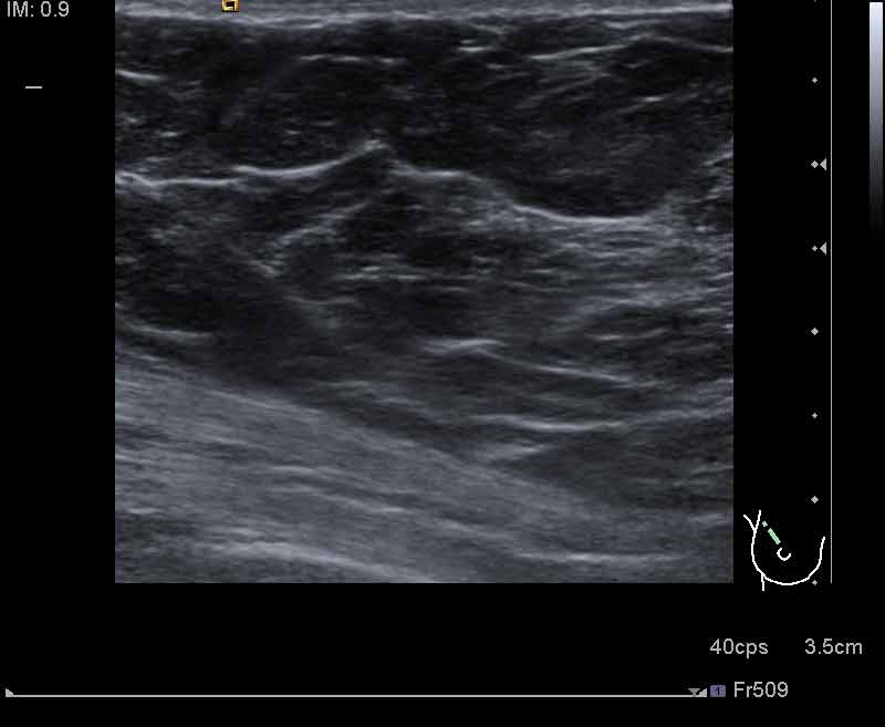Marcaje de seno por ultrasonido