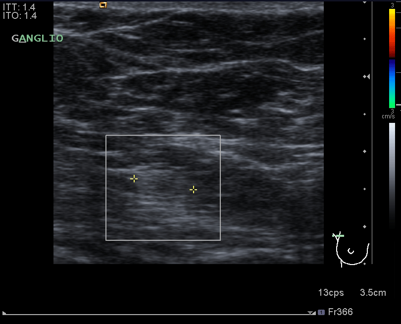 Marcaje de seno por ultrasonido