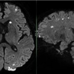 resonancia magnetica de cerebro
