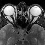 resonancia magnetica cerebro