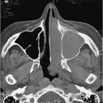 examen tomografía computarizada senos paranasales