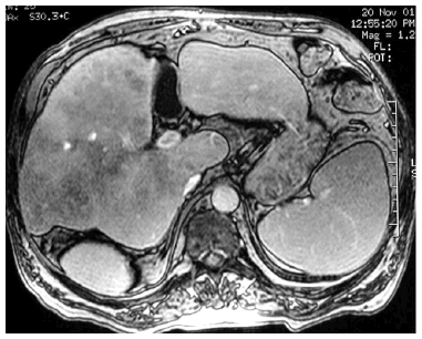 Resonancia magnética y cáncer de hígado