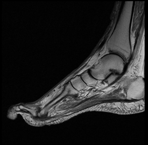 MRI FOOT SAGITTAL T1 IMAGE 2