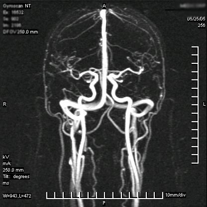 angio rm cereb ap