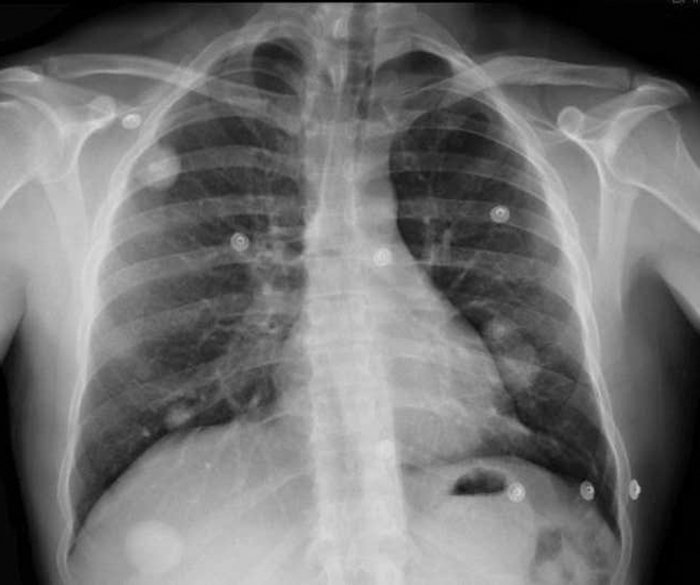 ¿Qué son los nódulos pulmonares?