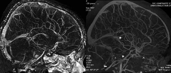 Angioresonancia de cráneo