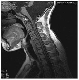 Resonancia magnética columna cervical en niños