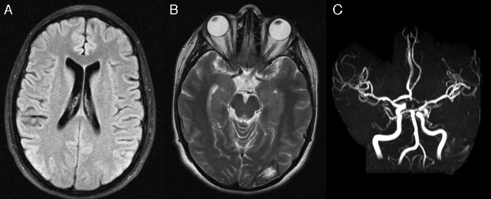 Derrame cerebral: reconoce sus síntomas