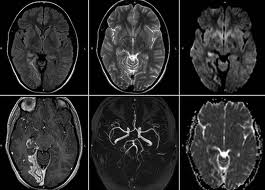 Derrame cerebral: reconoce sus síntomas