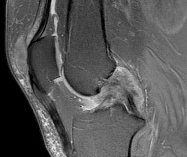 Resonancia magnética de la rodilla