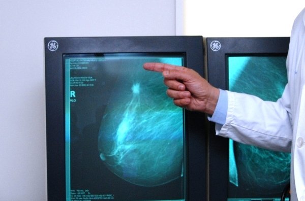 Cáncer de mama y embarazo