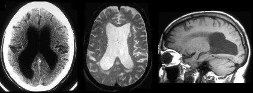 Si no es Alzheimer… podría ser hidrocefalia de presión normal