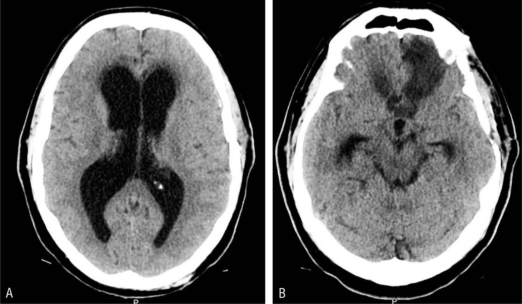 Si no es Alzheimer... podría ser hidrocefalia de presión normal