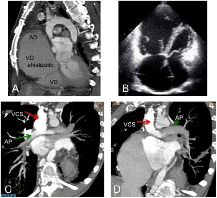 Reemplazo de la válvula cardíaca