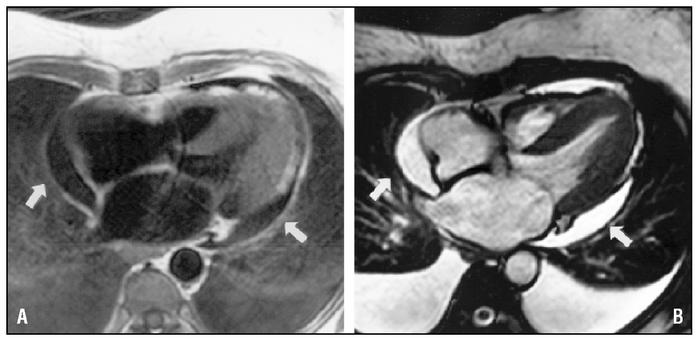 Reemplazo de la válvula cardíaca