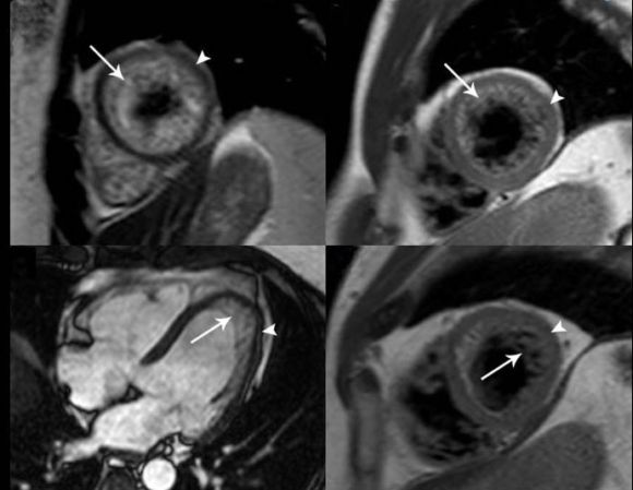 Reemplazo de la válvula cardíaca