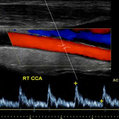 Accidente cerebrovascular (ACV) hemorrágico