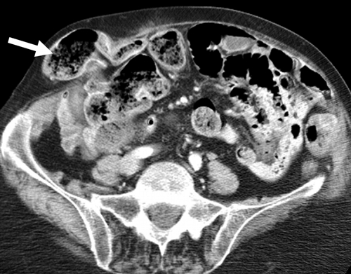 Diagnóstico de hernia inguinal