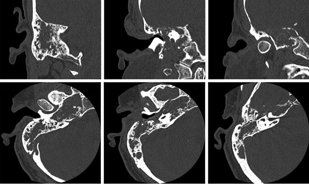 Síndrome de Ménière Síndrome de Ménière