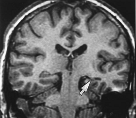 Crisis de ausencias o convulsiones en niños