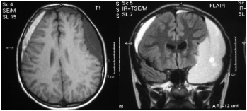 Hematoma subdural