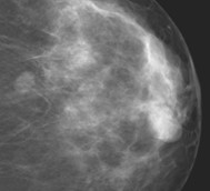 Tipos de cáncer de mama