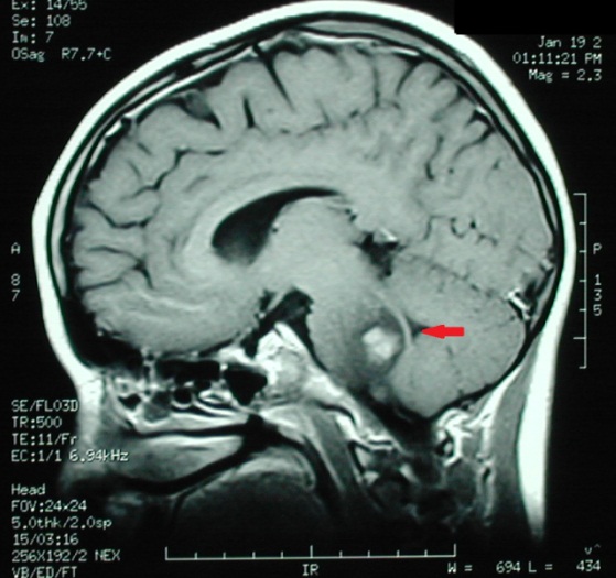 Neuroblastoma cáncer infantil