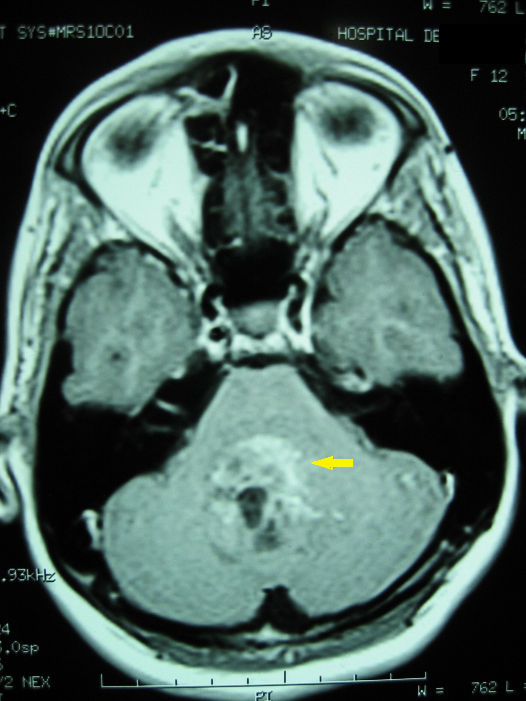 Neuroblastoma cáncer infantil