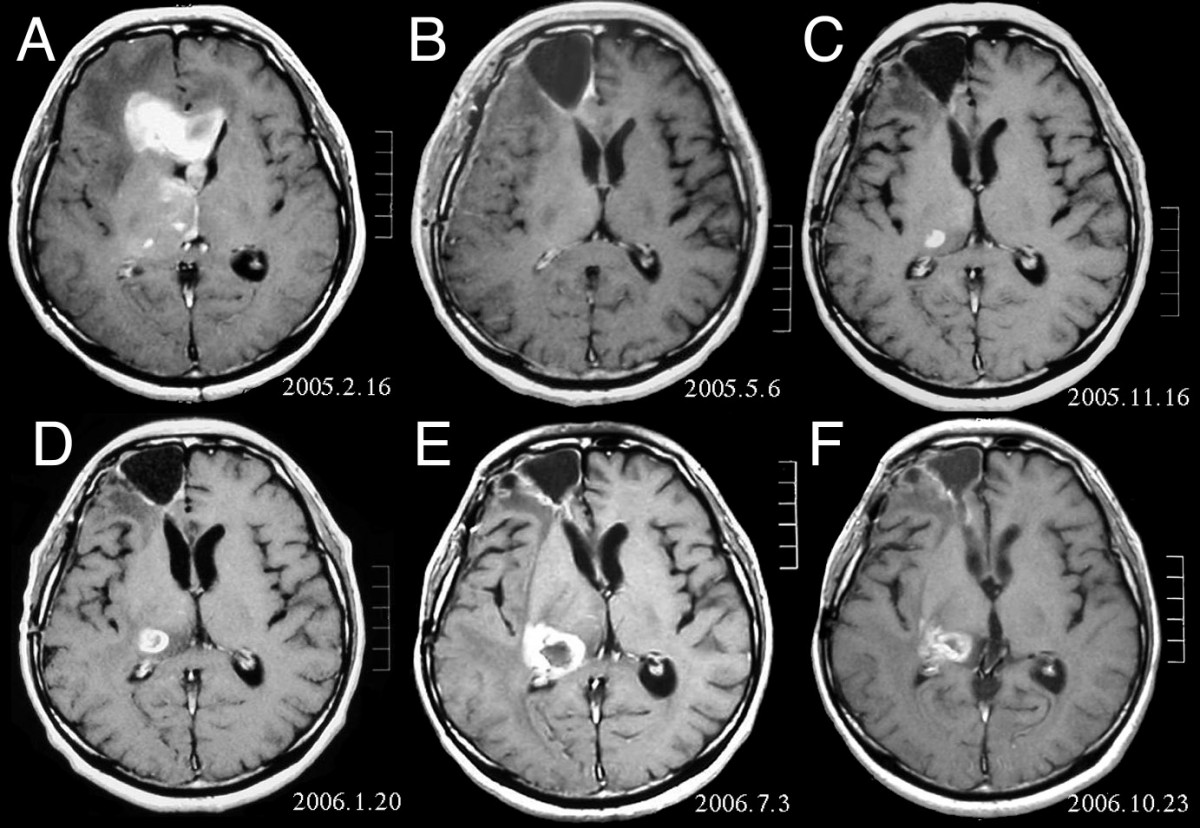 Neuroblastoma cáncer infantil