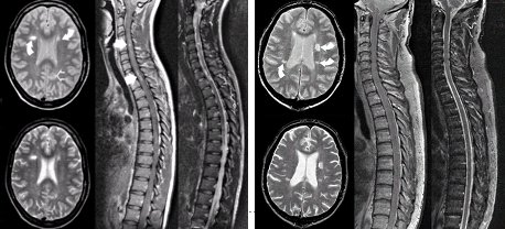 Esclerosis múltiple