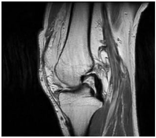 Lesiones del Ligamento Cruzado Anterior (LCA)