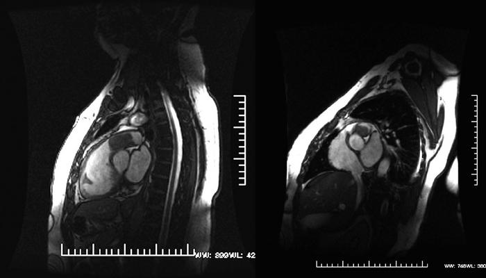 Fibrosis pulmonar