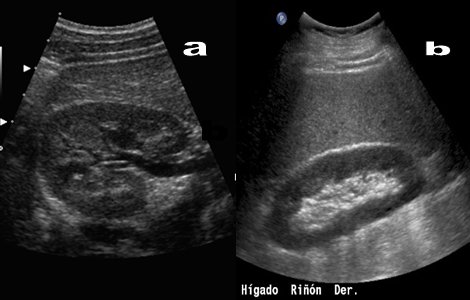 Hígado graso y fibrosis hepática