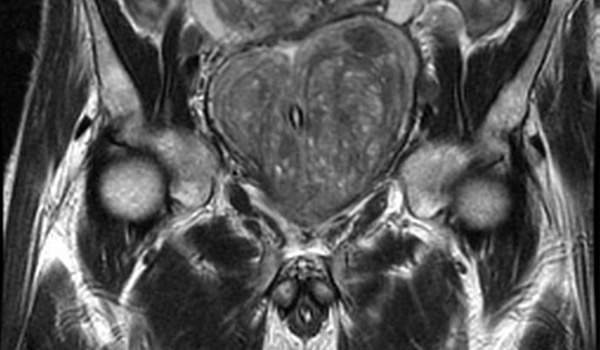 cáncer de próstata imagenologia care este problema cu prostatita