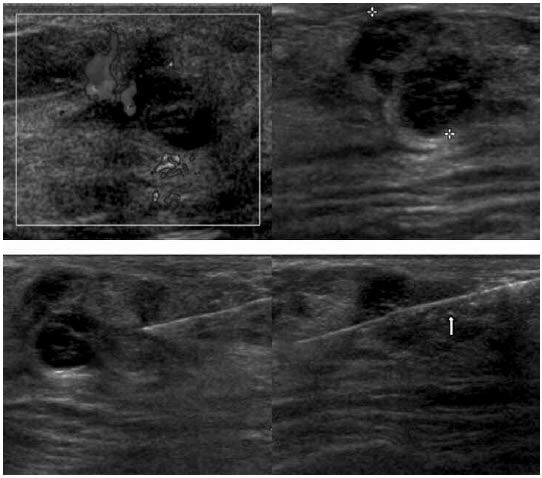 Biopsia de mama guiada por ultrasonido