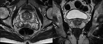 Cáncer de próstata, diagnóstico