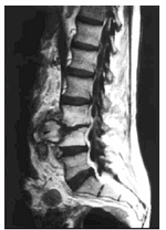 Absceso de la médula espinal