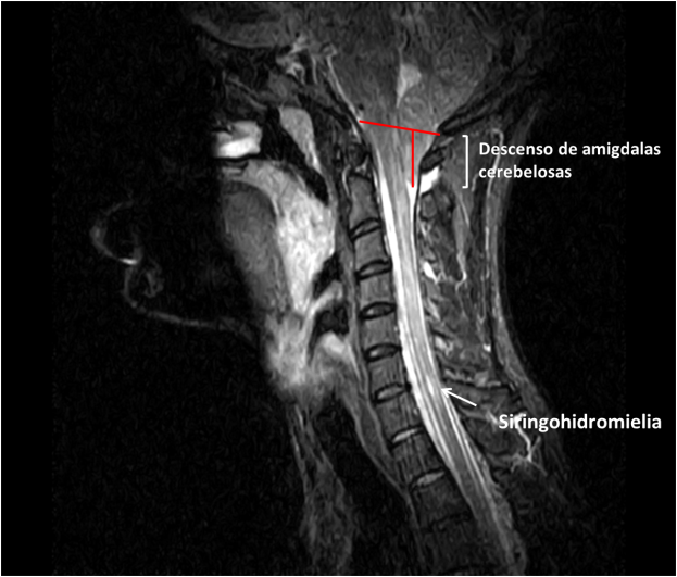 Malformación de Chiari tipo I