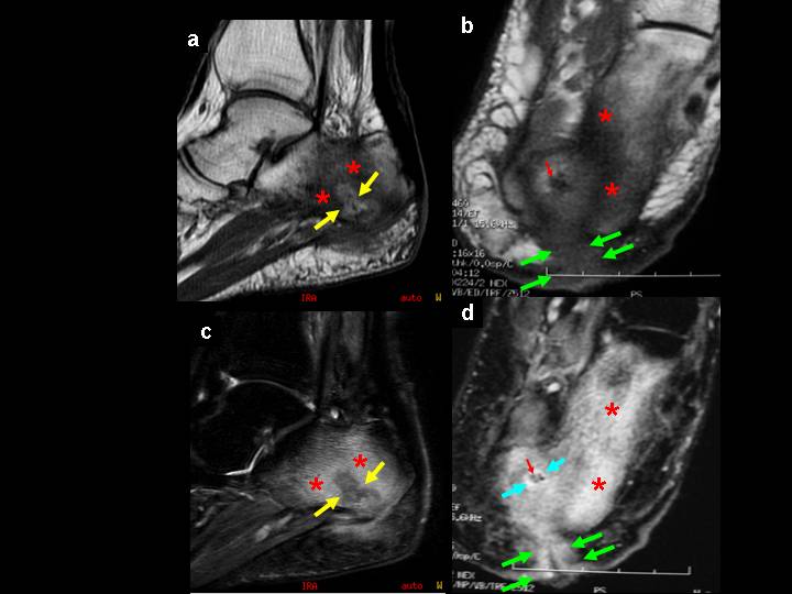 Disgnóstico de osteomielitis Disgnóstico de osteomielitis