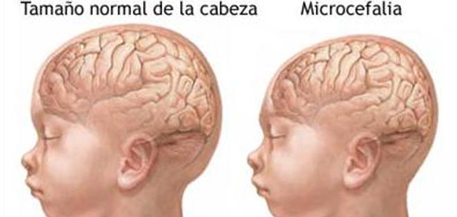 ¿Qué es y que causa la microcefalia?