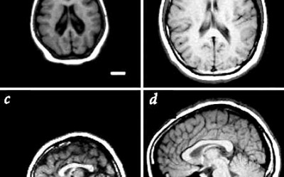 ¿Qué es y que causa la microcefalia?