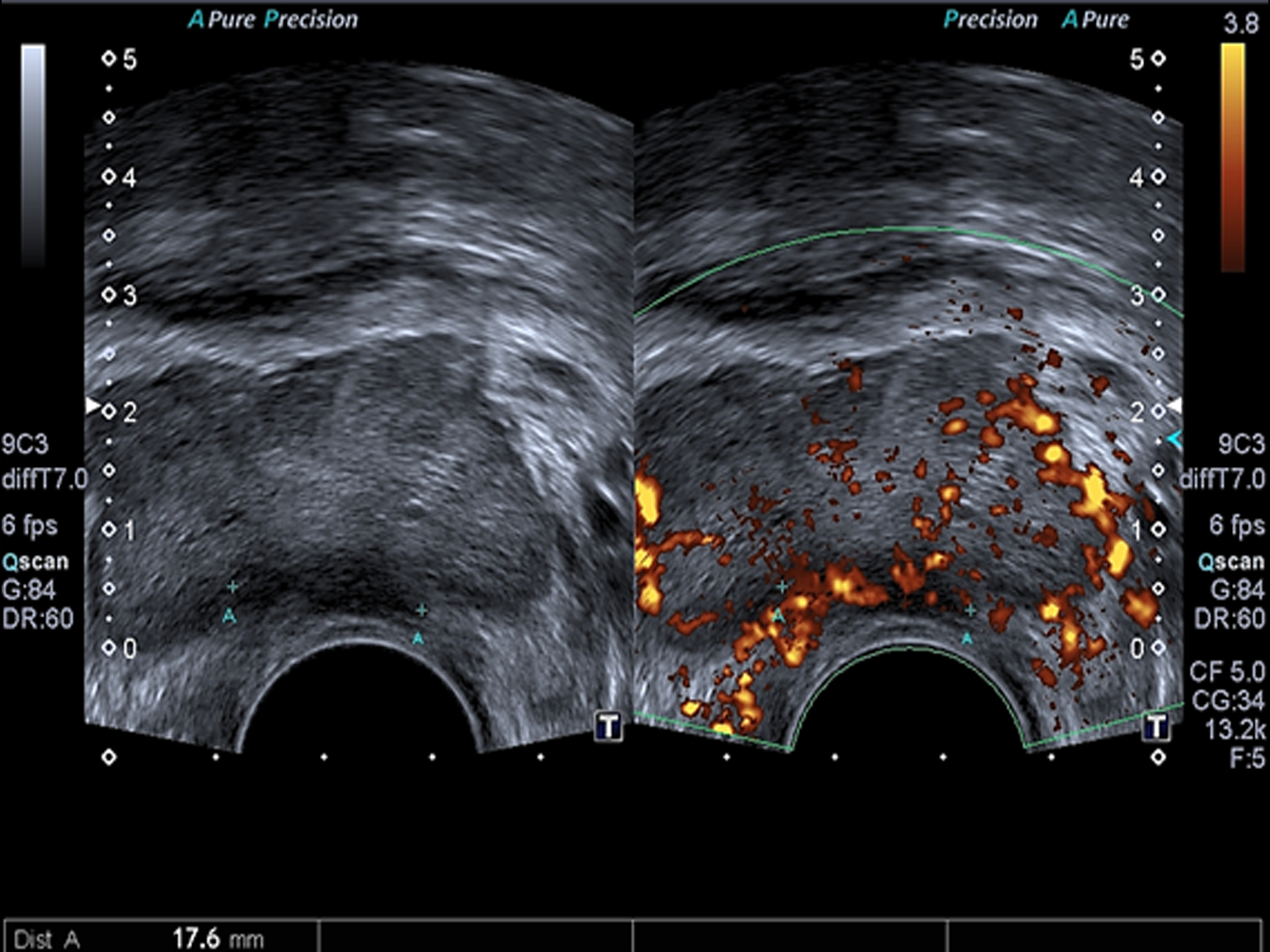 Cancer de prostata ultrassonografia. Cancer testicular seguimiento - Cancer de prostata ultrasonido