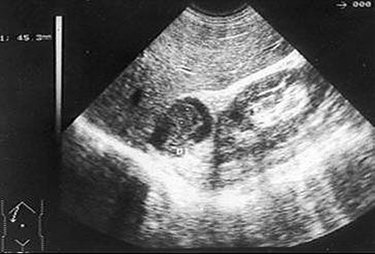 Adenoma suprarrenal Diagnóstico