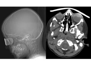 Tomografía Axial en niños